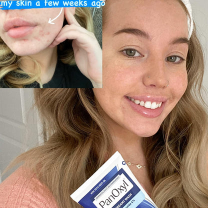 PanOxyl Benzoyl Peroxide ACNE Creamy Wash 4% (170g)| Acne Foaming Wash 10%(156g)