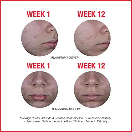 Neutrogena Stubborn Acne with Benzoyl Peroxide (25% Micronized BPO) 56g