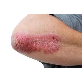 MG217 PSORIASIS MEDICATED MOISTURIZING CREAM & MULTI SYMPTOM OINTMENT