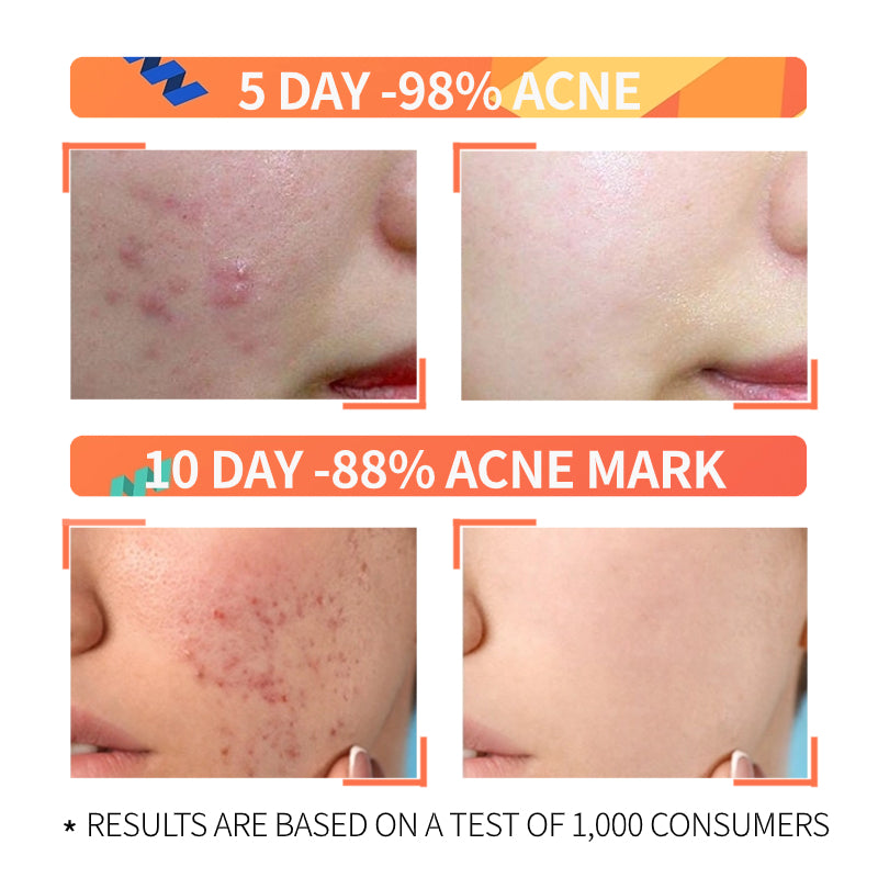 The Ordinary Niacinamide Serum Oily Skin Pimple Acne mark Remover Niacinamide 10% + Zinc 1%
